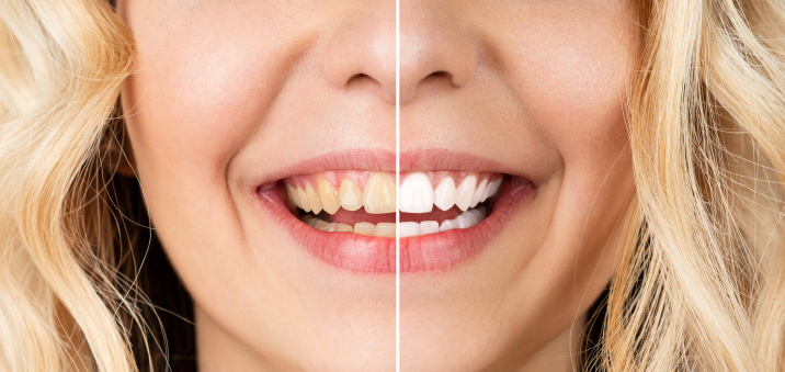 Before and after teeth whitening at The Smile Spot in Round Rock TX